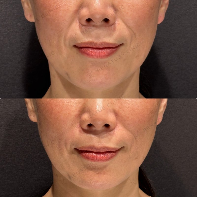 ほうれい線ヒアルロン酸ボリフト症例写真