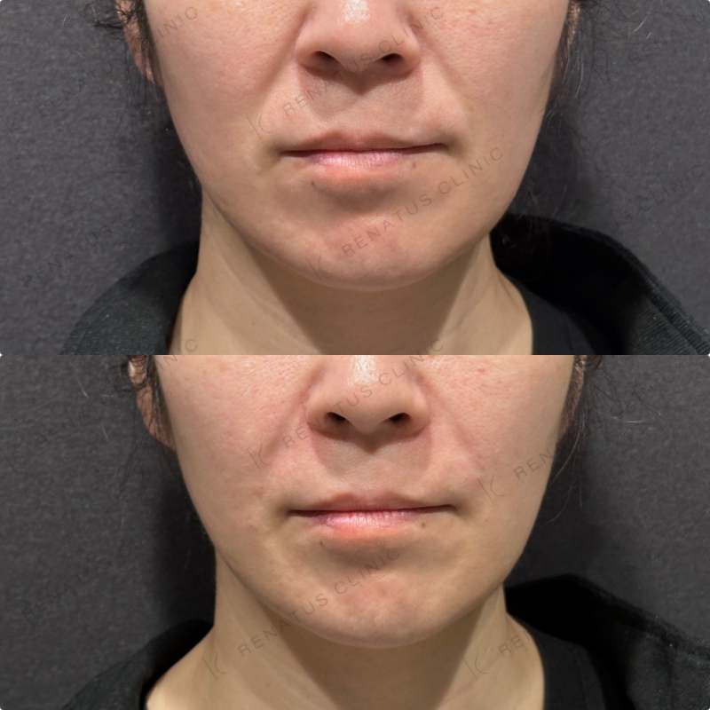 ほうれい線ヒアルロン酸ボリフト症例写真