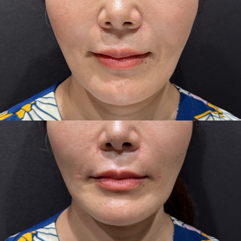 ほうれい線ヒアルロン酸ボリフト症例写真