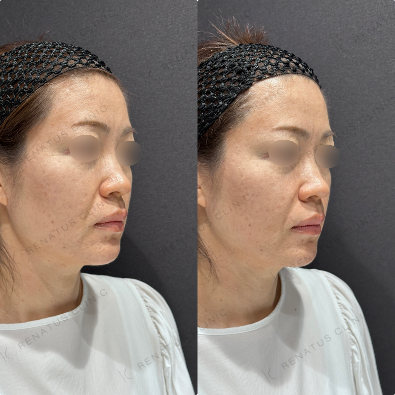 ほうれい線ヒアルロン酸ボリフト・ダイヤモンドフィール症例写真