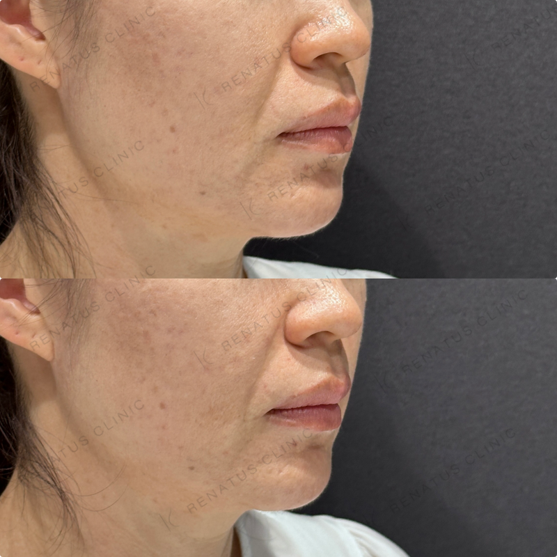 ほうれい線ヒアルロン酸ボリフト・ダイヤモンドフィール症例写真