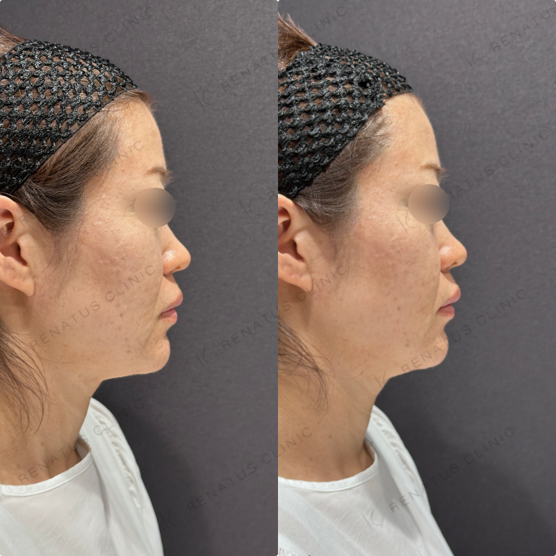 ほうれい線ヒアルロン酸ボリフト・ダイヤモンドフィール症例写真