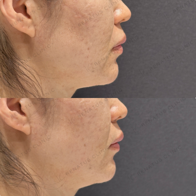 ほうれい線ヒアルロン酸ボリフト・ダイヤモンドフィール症例写真