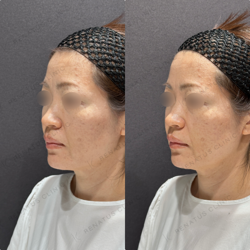 ほうれい線ヒアルロン酸ボリフト・ダイヤモンドフィール症例写真