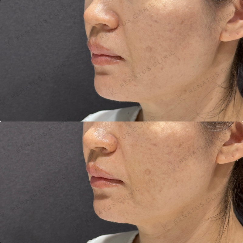 ほうれい線ヒアルロン酸ボリフト・ダイヤモンドフィール症例写真