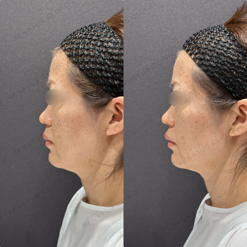 ほうれい線ヒアルロン酸ボリフト・ダイヤモンドフィール症例写真