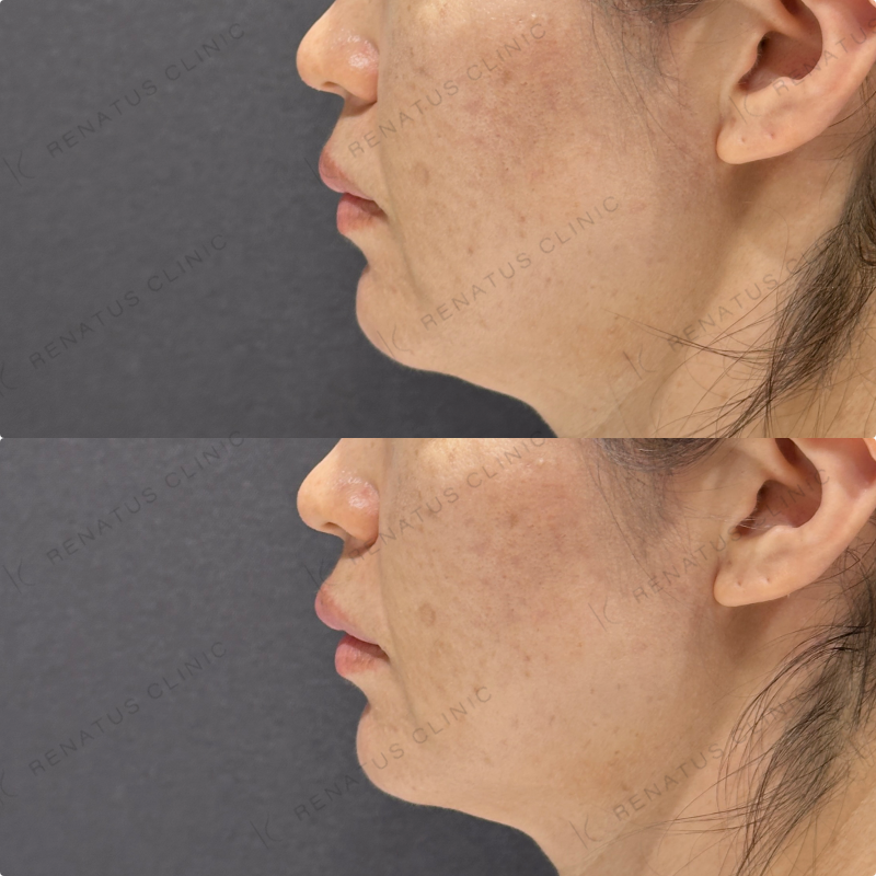 ほうれい線ヒアルロン酸ボリフト・ダイヤモンドフィール症例写真