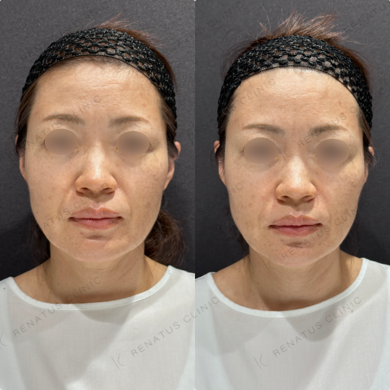 ほうれい線ヒアルロン酸ボリフト・ダイヤモンドフィール症例写真