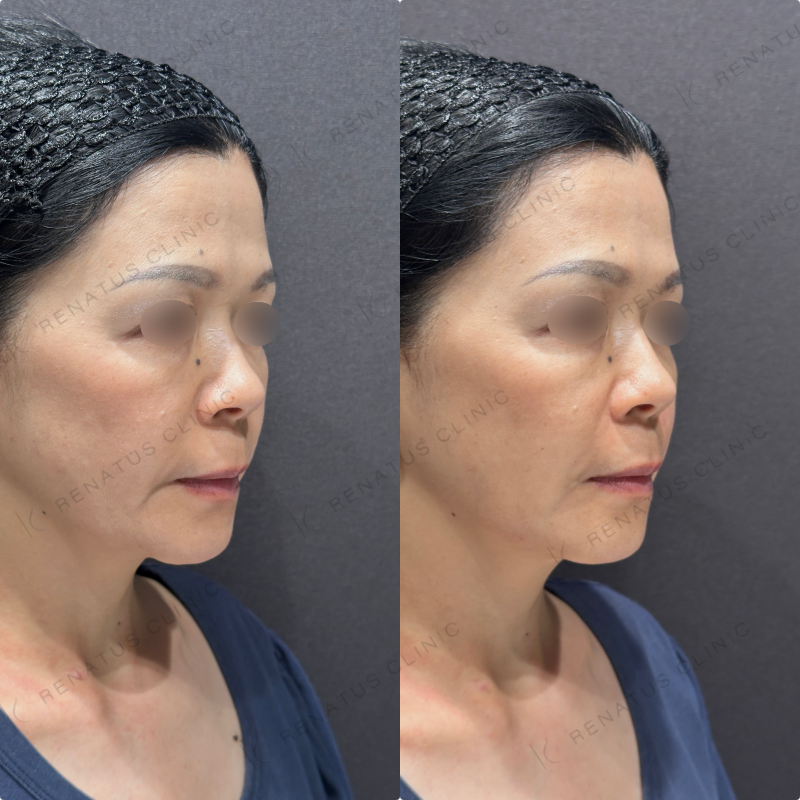 ほうれい線・マリオネットラインヒアルロン酸ボリフト症例写真