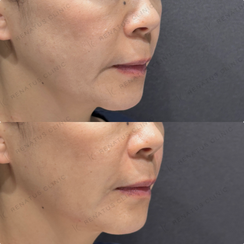 ほうれい線・マリオネットラインヒアルロン酸ボリフト症例写真