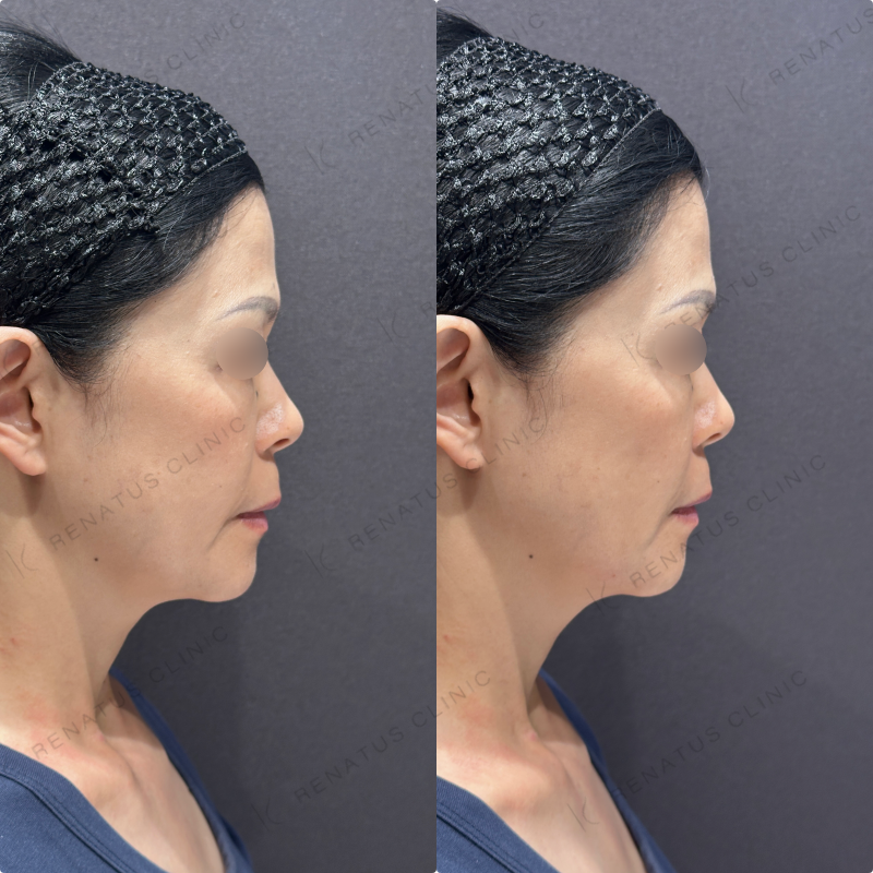 ほうれい線・マリオネットラインヒアルロン酸ボリフト症例写真