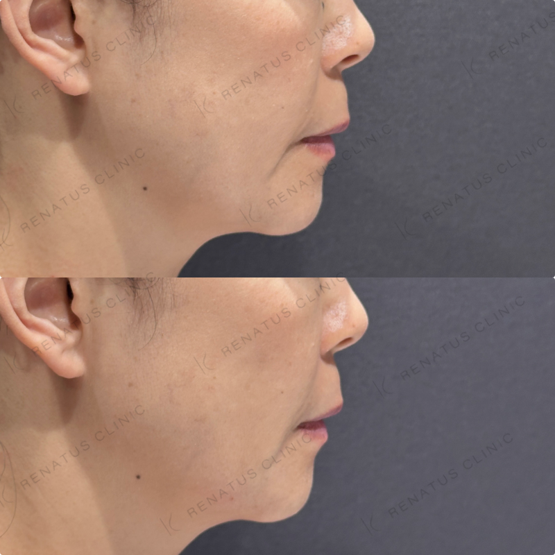 ほうれい線・マリオネットラインヒアルロン酸ボリフト症例写真