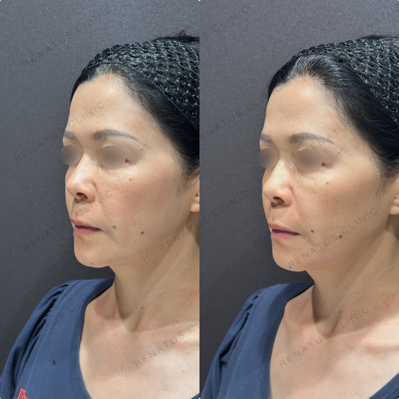 ほうれい線・マリオネットラインヒアルロン酸ボリフト症例写真