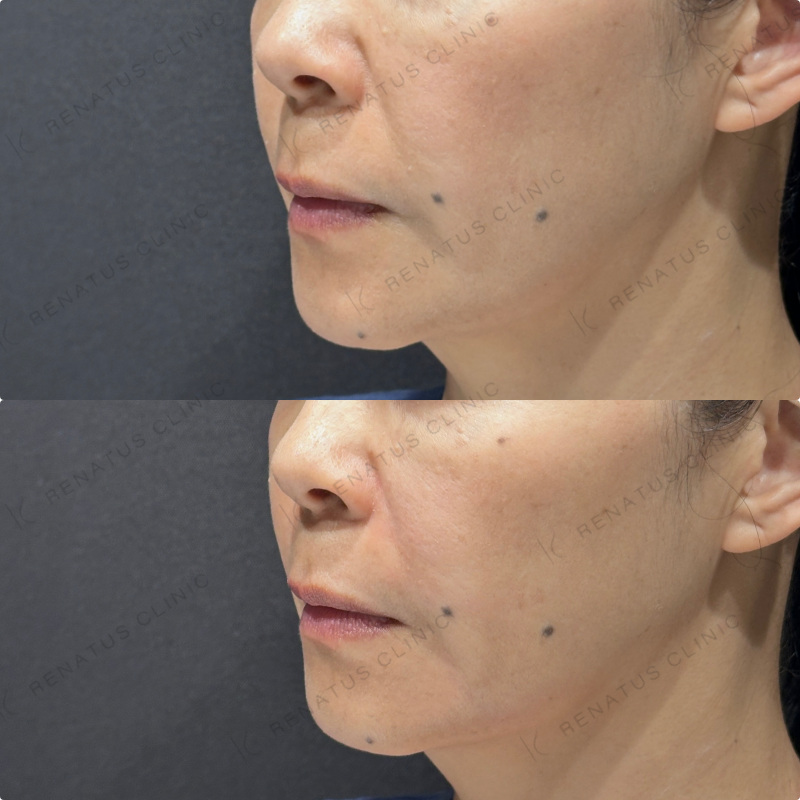 ほうれい線・マリオネットラインヒアルロン酸ボリフト症例写真