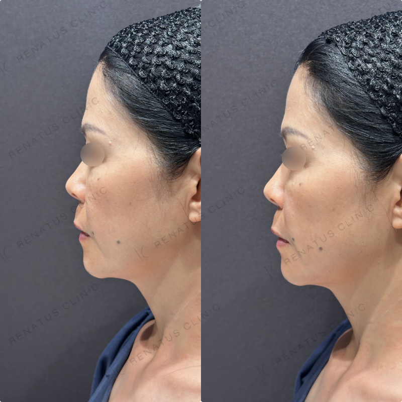 ほうれい線・マリオネットラインヒアルロン酸ボリフト症例写真