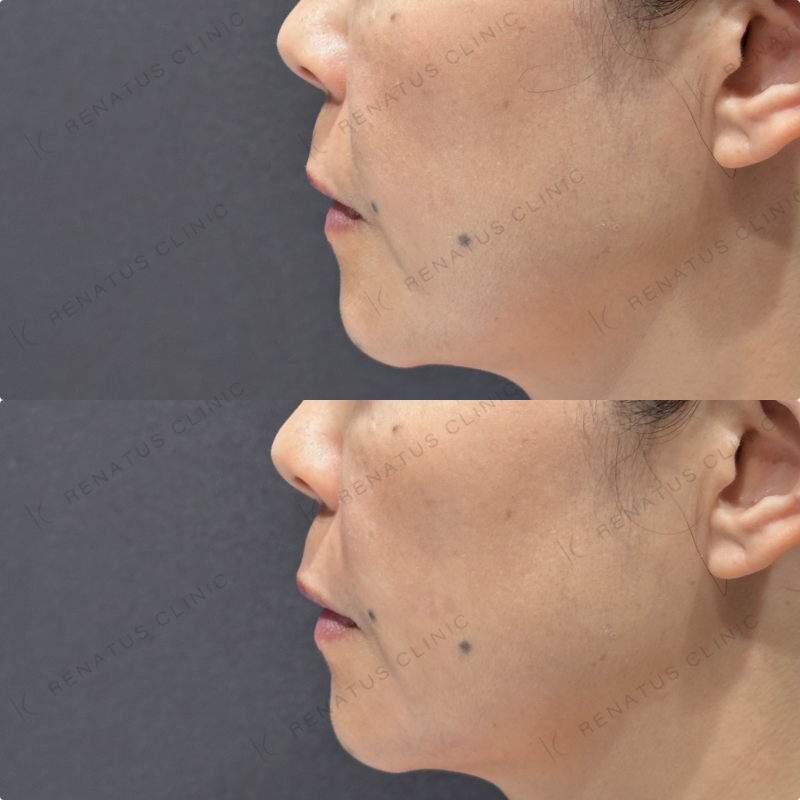 ほうれい線・マリオネットラインヒアルロン酸ボリフト症例写真