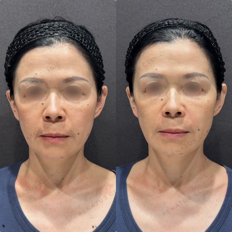 ほうれい線・マリオネットラインヒアルロン酸ボリフト症例写真