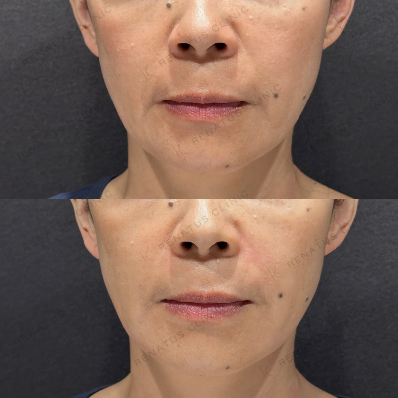 ほうれい線・マリオネットラインヒアルロン酸ボリフト症例写真