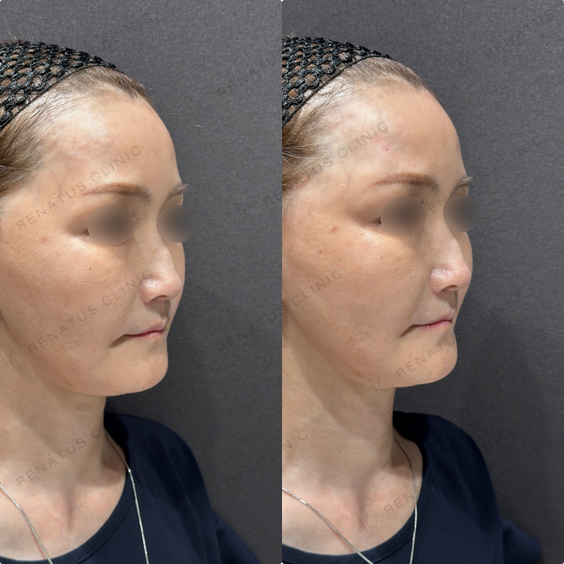 こめかみヒアルロン酸ボリューマ症例写真