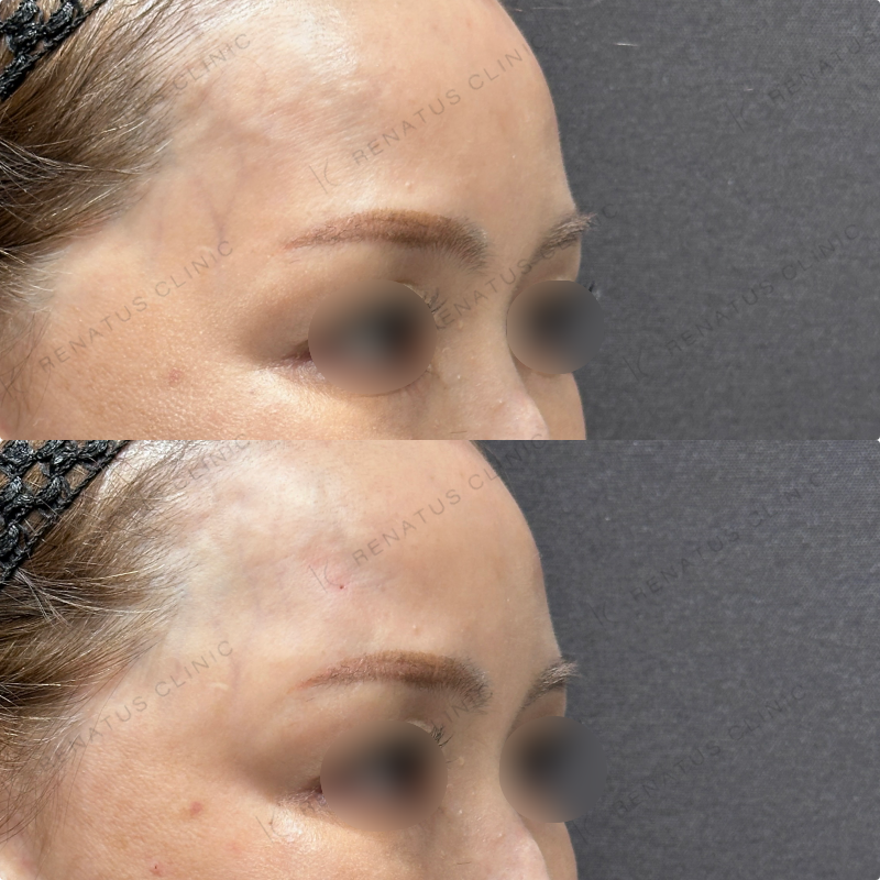 こめかみヒアルロン酸ボリューマ症例写真