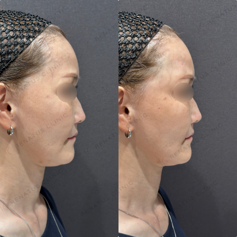 こめかみヒアルロン酸ボリューマ症例写真