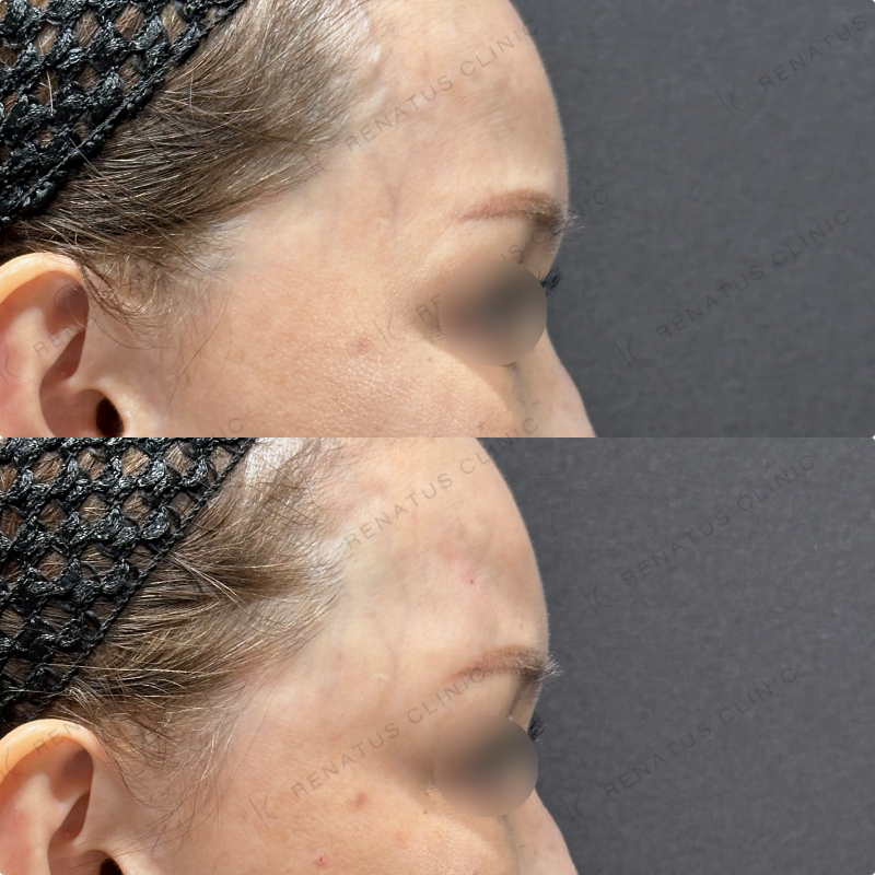 こめかみヒアルロン酸ボリューマ症例写真