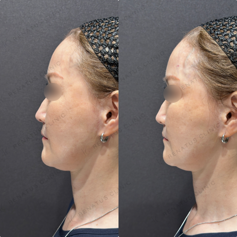 こめかみヒアルロン酸ボリューマ症例写真