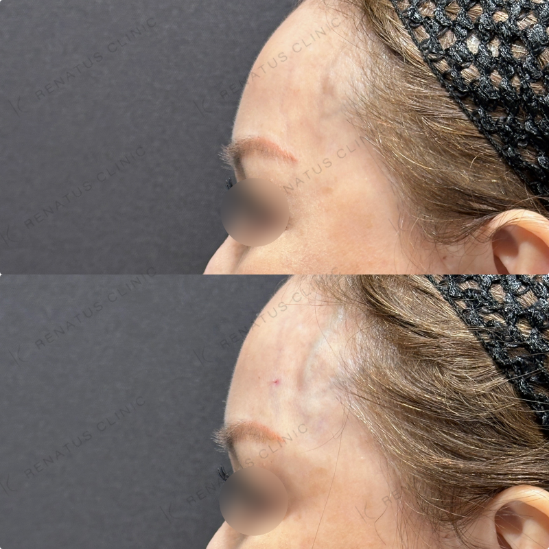 こめかみヒアルロン酸ボリューマ症例写真