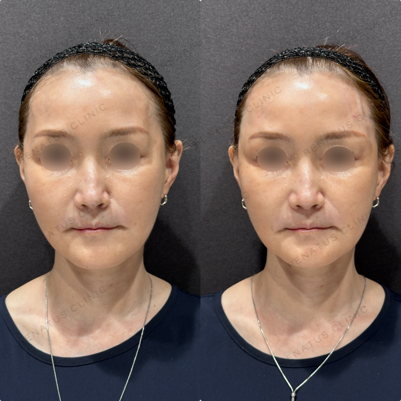 こめかみヒアルロン酸ボリューマ症例写真