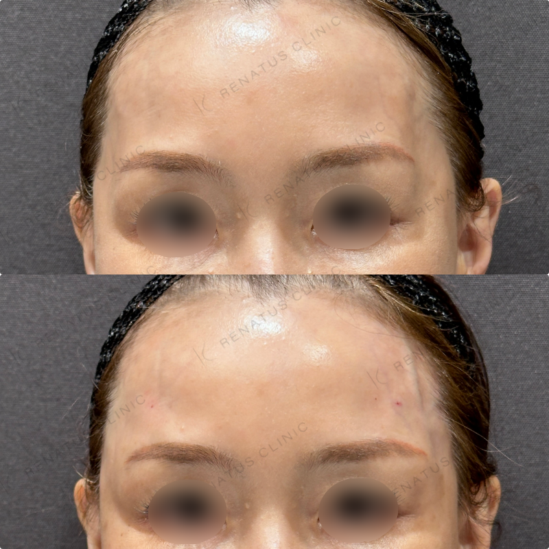 こめかみヒアルロン酸ボリューマ症例写真