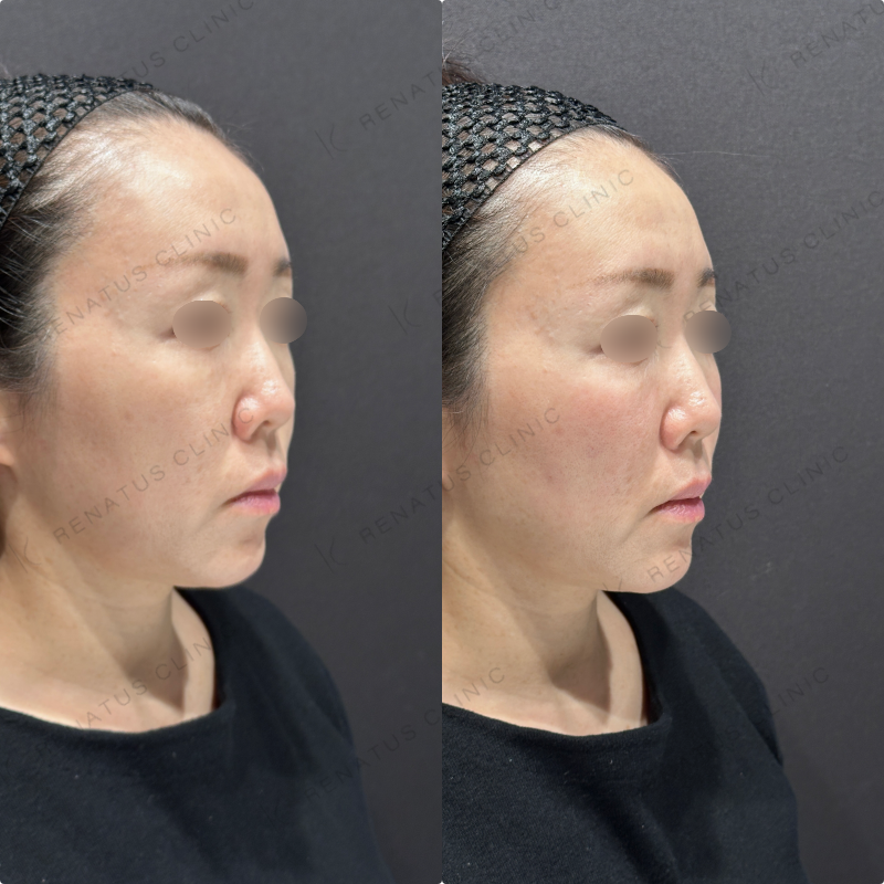 ゴルゴラインヒアルロン酸ボリフト症例写真