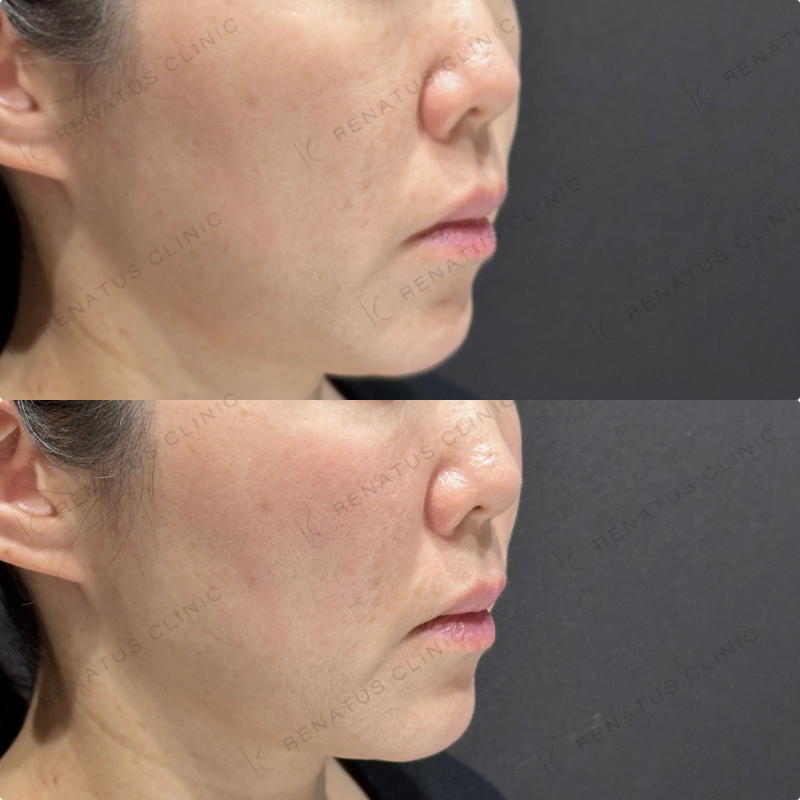 ゴルゴラインヒアルロン酸ボリフト症例写真