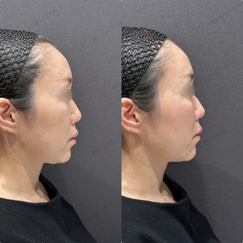 ゴルゴラインヒアルロン酸ボリフト症例写真