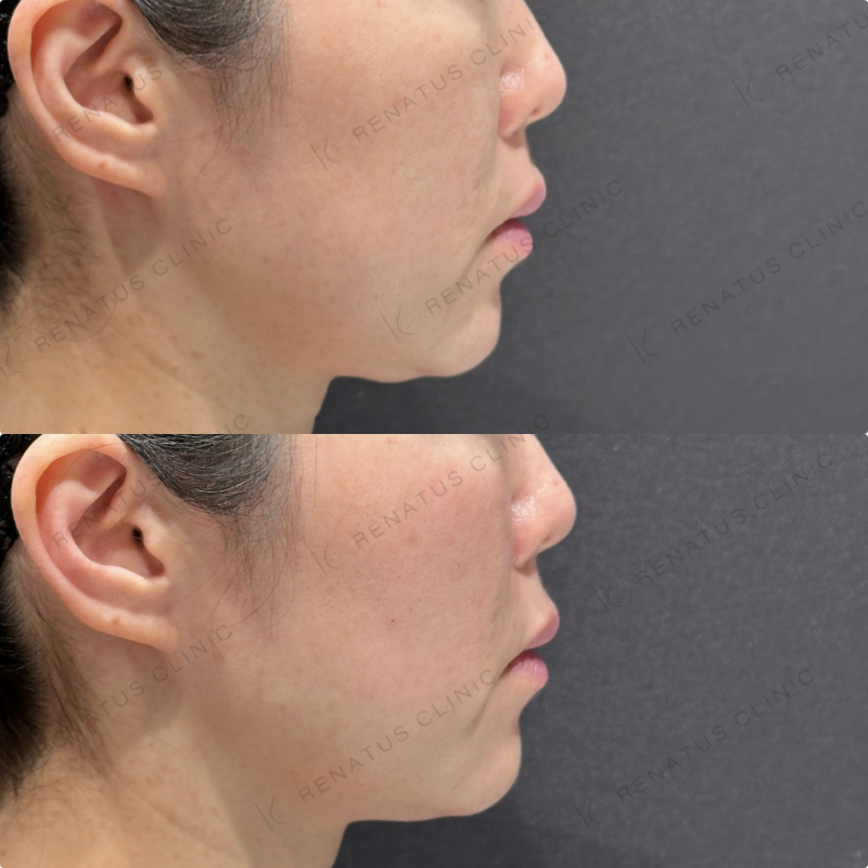 ゴルゴラインヒアルロン酸ボリフト症例写真