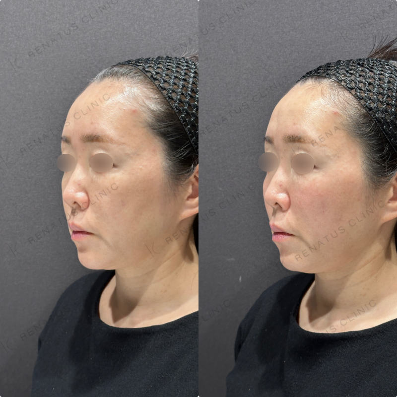 ゴルゴラインヒアルロン酸ボリフト症例写真