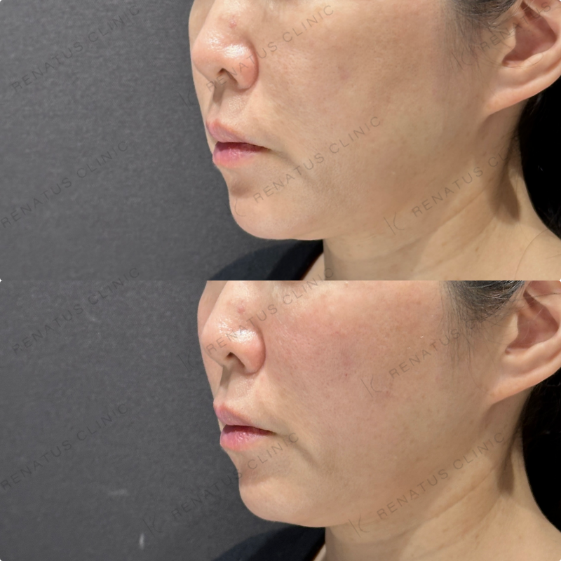 ゴルゴラインヒアルロン酸ボリフト症例写真