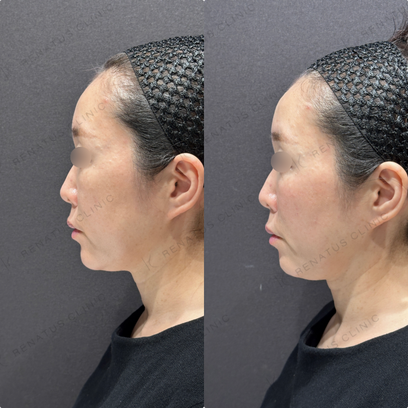 ゴルゴラインヒアルロン酸ボリフト症例写真