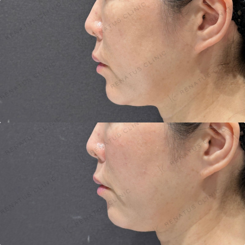 ゴルゴラインヒアルロン酸ボリフト症例写真