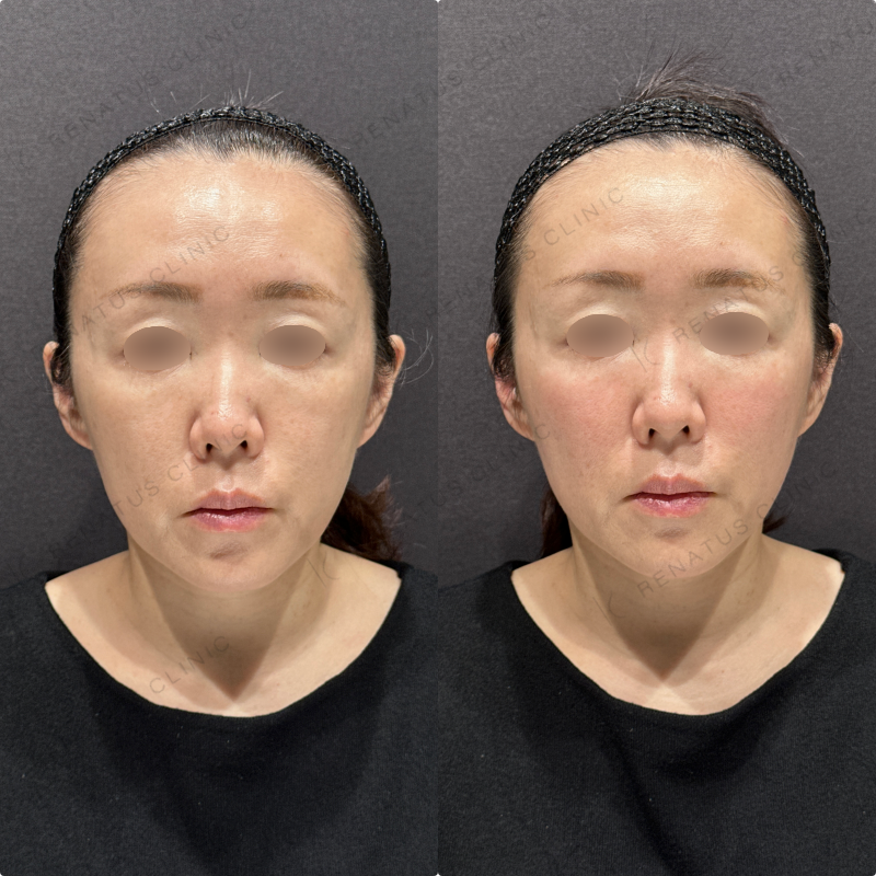 ゴルゴラインヒアルロン酸ボリフト症例写真