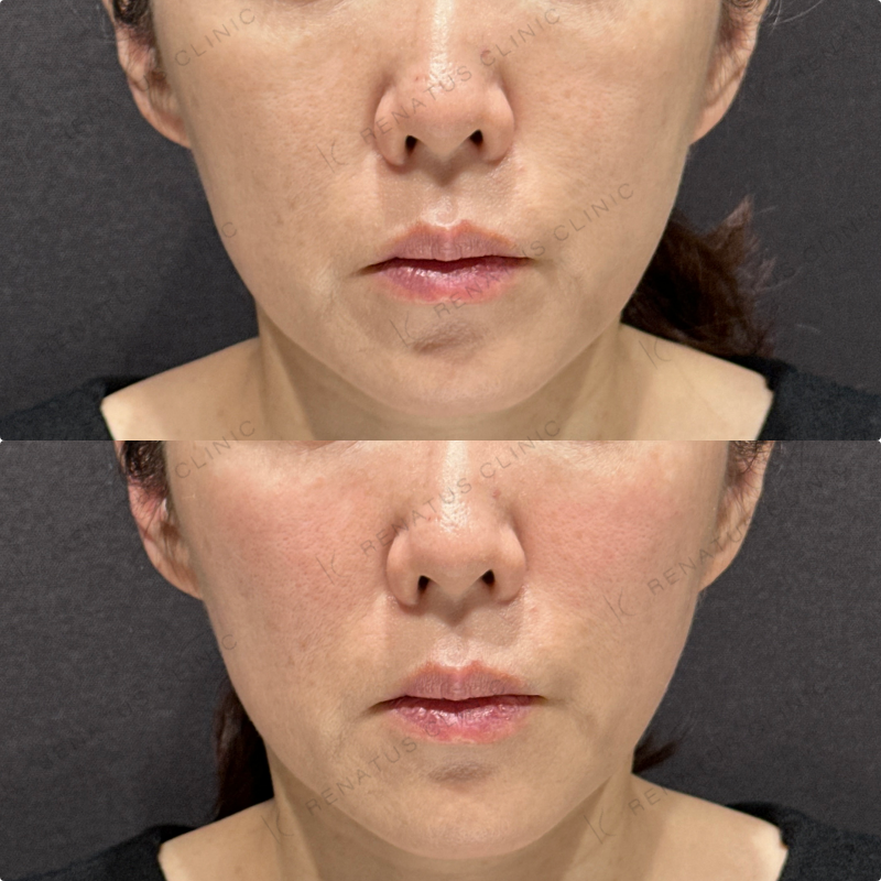 ゴルゴラインヒアルロン酸ボリフト症例写真