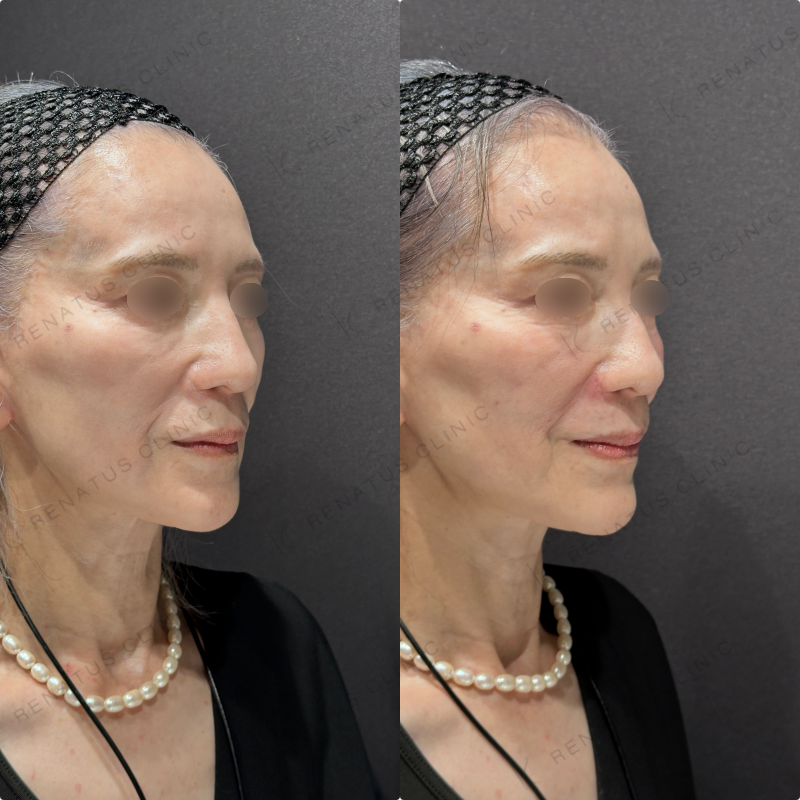 ゴルゴライン・ほうれい線ヒアルロン酸ボリフト症例写真