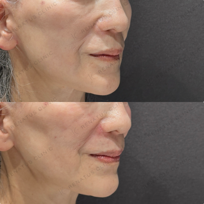 ゴルゴライン・ほうれい線ヒアルロン酸ボリフト症例写真