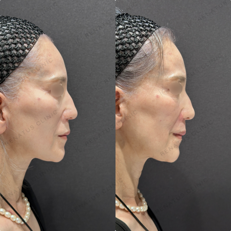 ゴルゴライン・ほうれい線ヒアルロン酸ボリフト症例写真