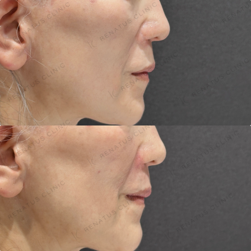 ゴルゴライン・ほうれい線ヒアルロン酸ボリフト症例写真