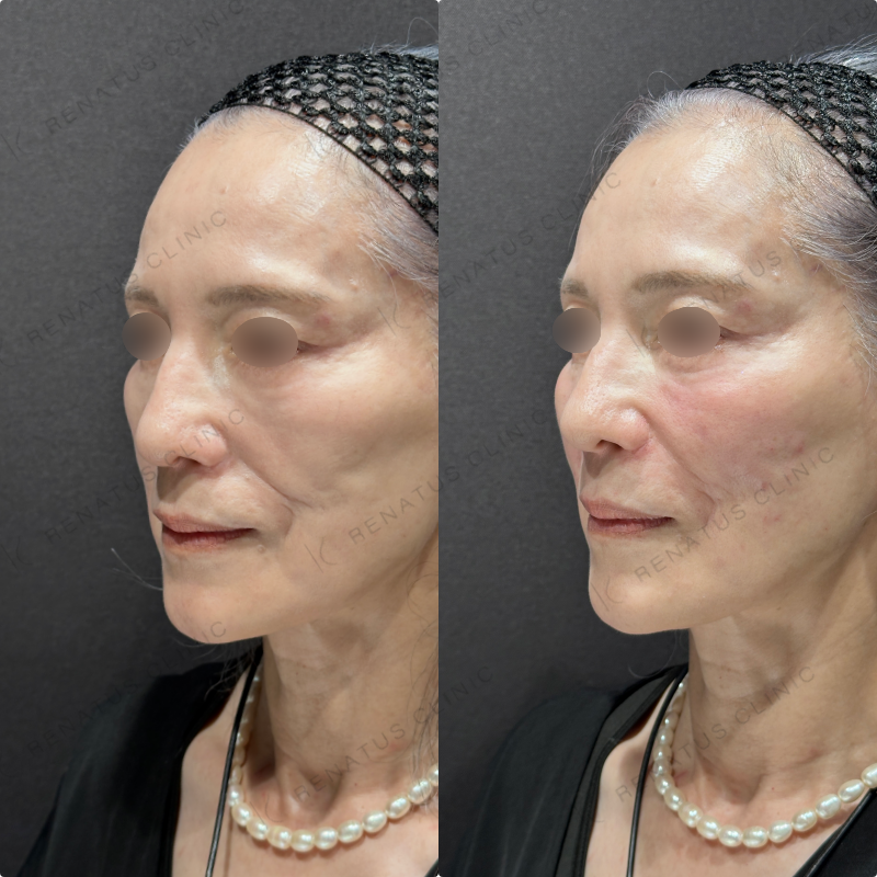 ゴルゴライン・ほうれい線ヒアルロン酸ボリフト症例写真