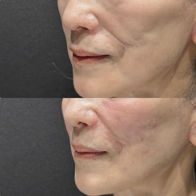 ゴルゴライン・ほうれい線ヒアルロン酸ボリフト症例写真