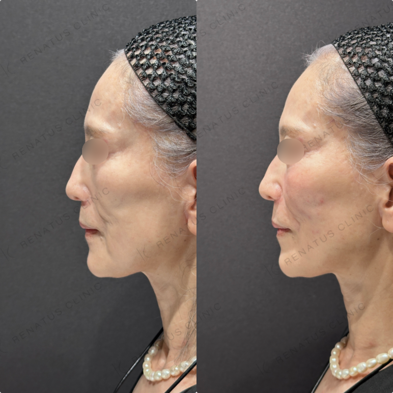 ゴルゴライン・ほうれい線ヒアルロン酸ボリフト症例写真