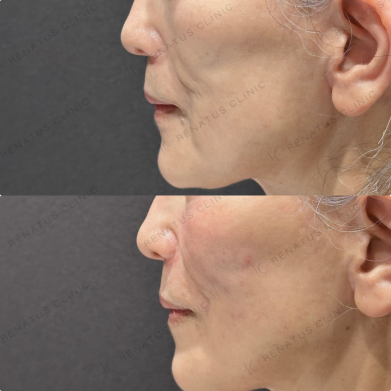 ゴルゴライン・ほうれい線ヒアルロン酸ボリフト症例写真