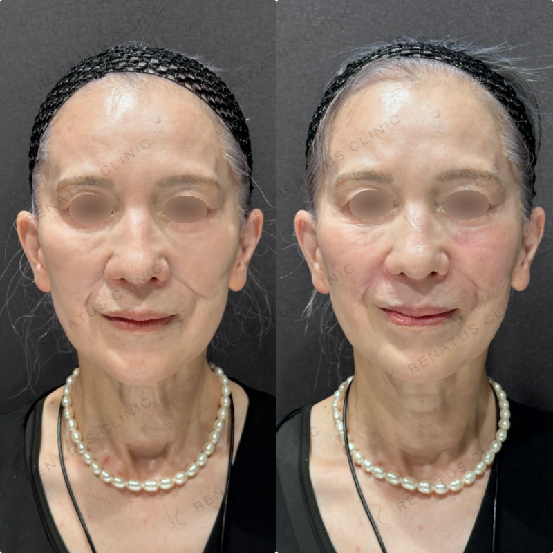 ゴルゴライン・ほうれい線ヒアルロン酸ボリフト症例写真