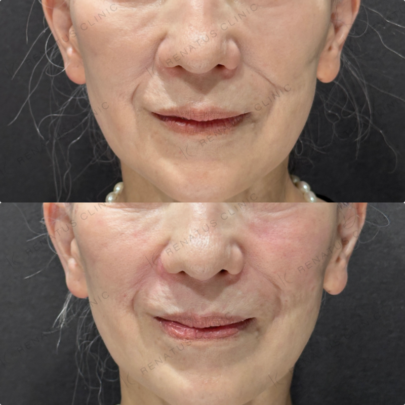 ゴルゴライン・ほうれい線ヒアルロン酸ボリフト症例写真